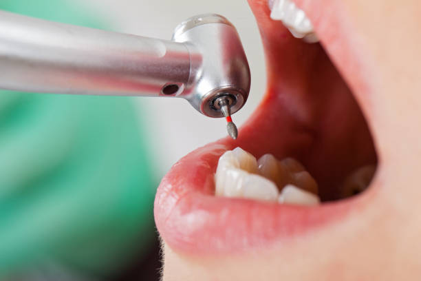 Best Emergency Wisdom Teeth Removal in Tekamah, NE